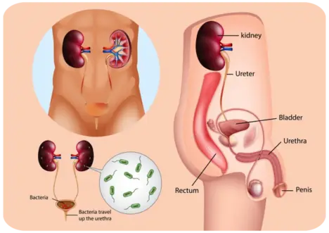 Riñones enfermos por bacterias